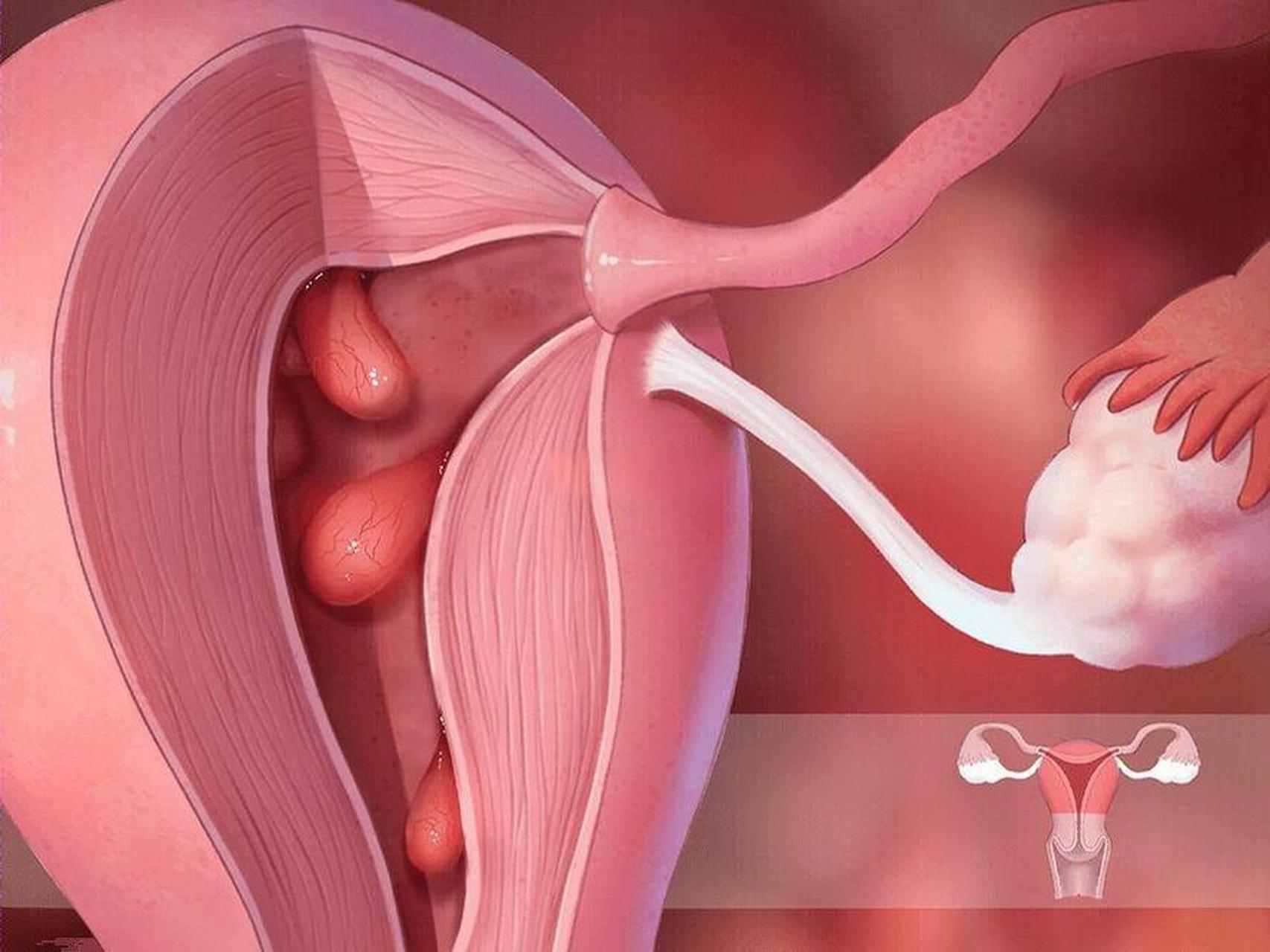 说了不下800遍,子宫内膜息肉做宫腔镜是自讨苦吃!