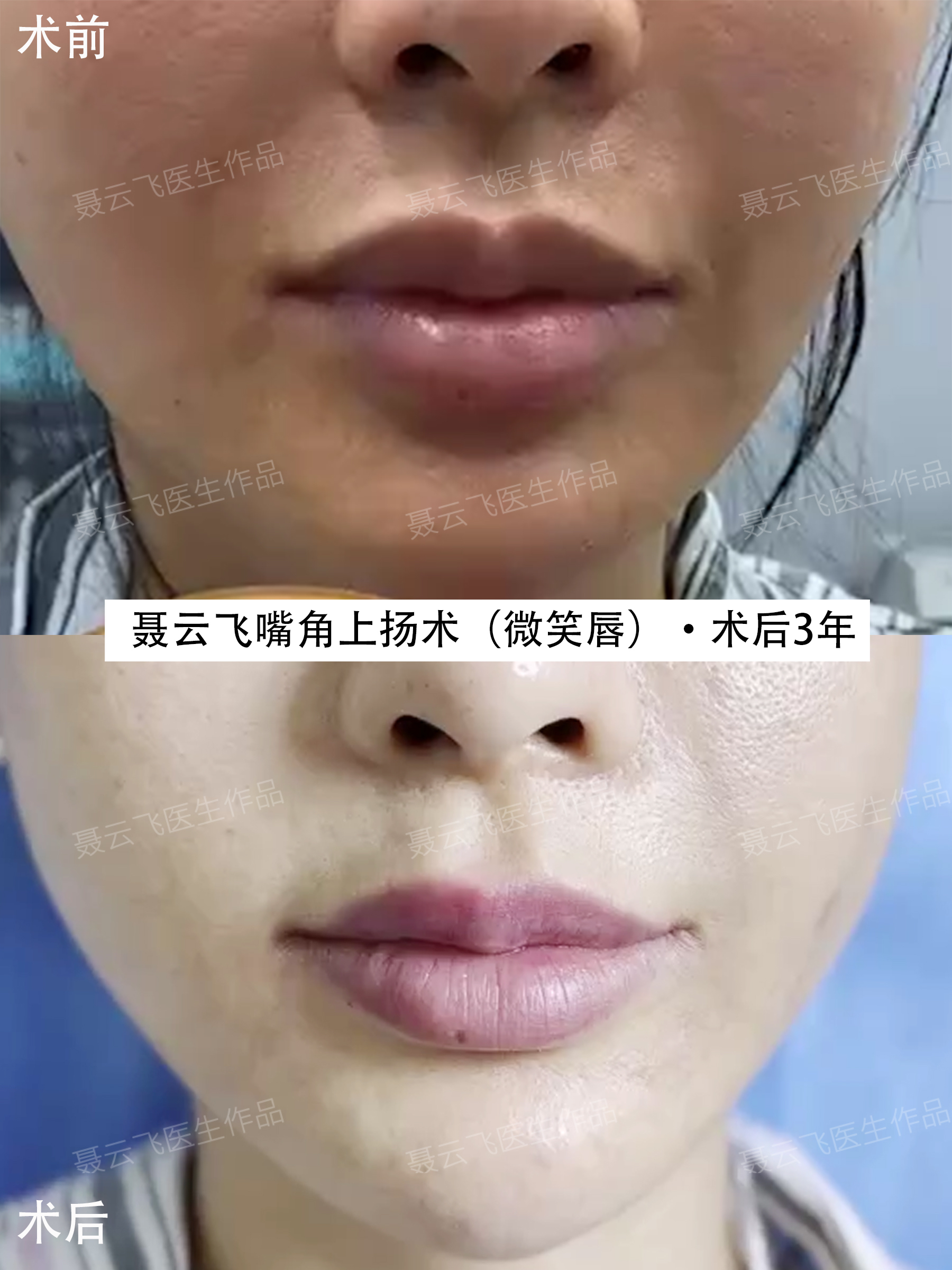 聂云飞嘴角上扬术(微笑唇)·术后3年