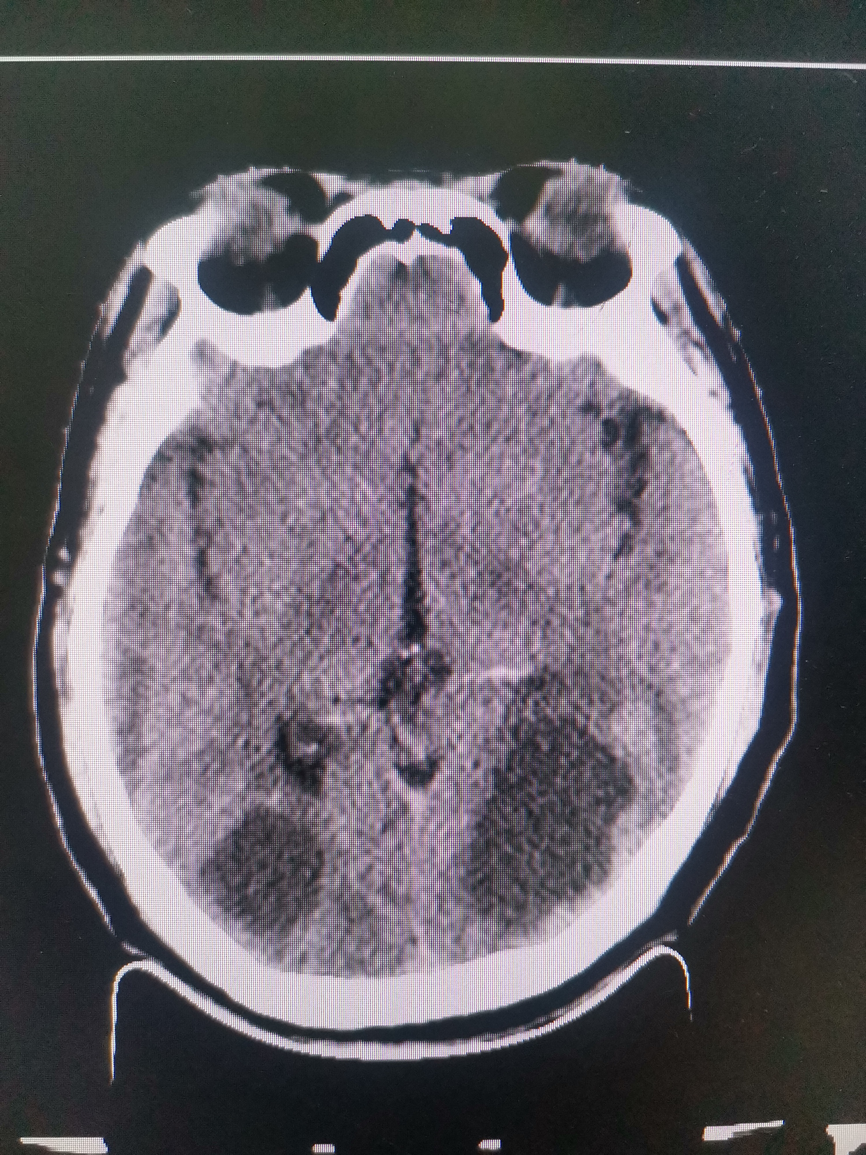 脑转移瘤有什么特点?
