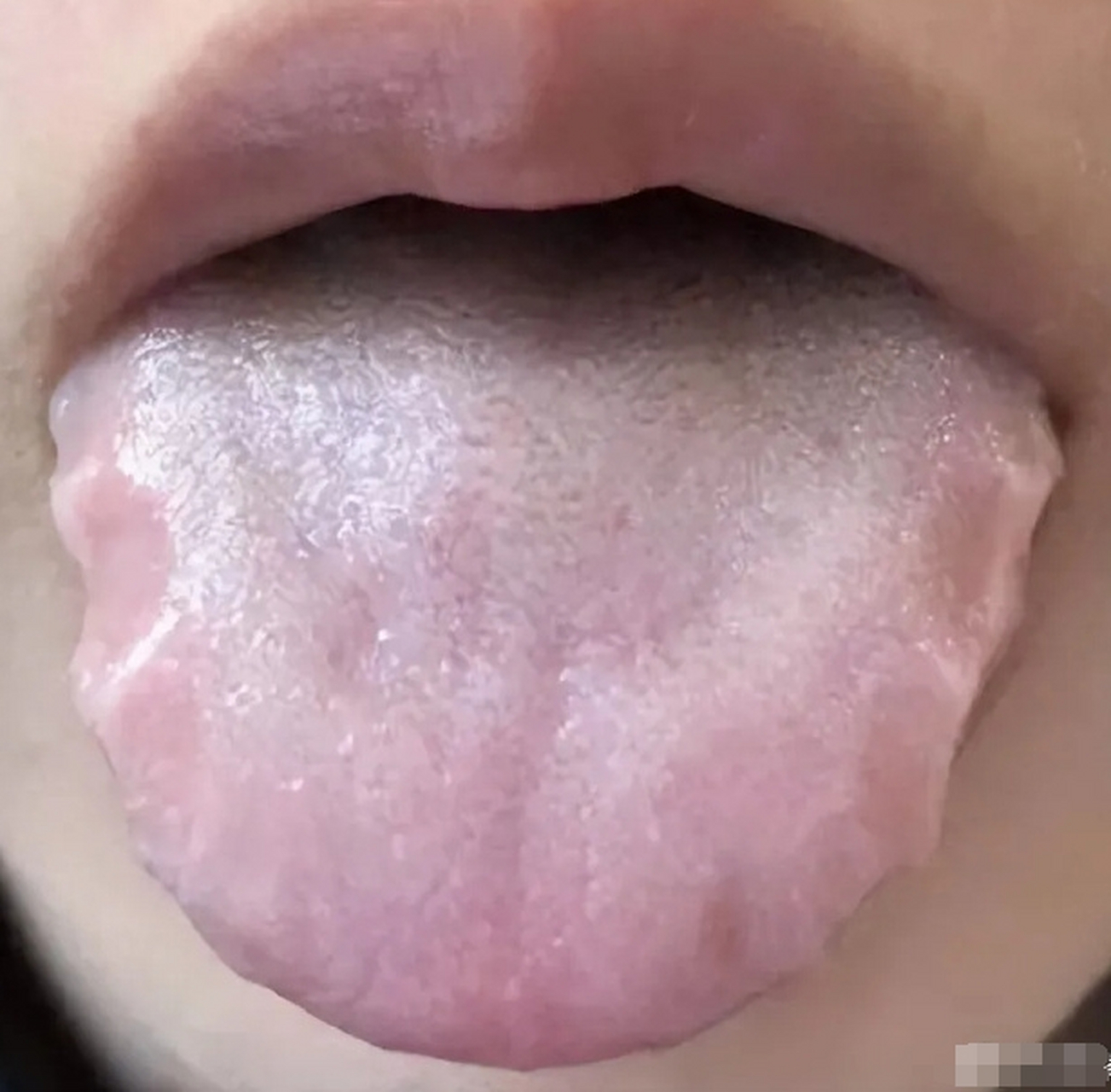 1分钟,教你掌握肾阳虚证的舌象特征,临床症状,调理方法!