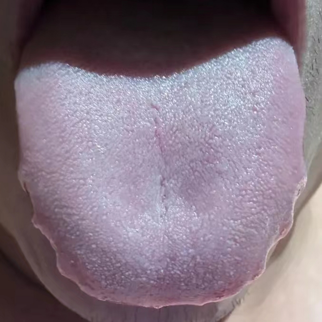 这样的舌头,就算再严重的瘀血,也切忌用血府逐瘀丸,桃红四物丸!