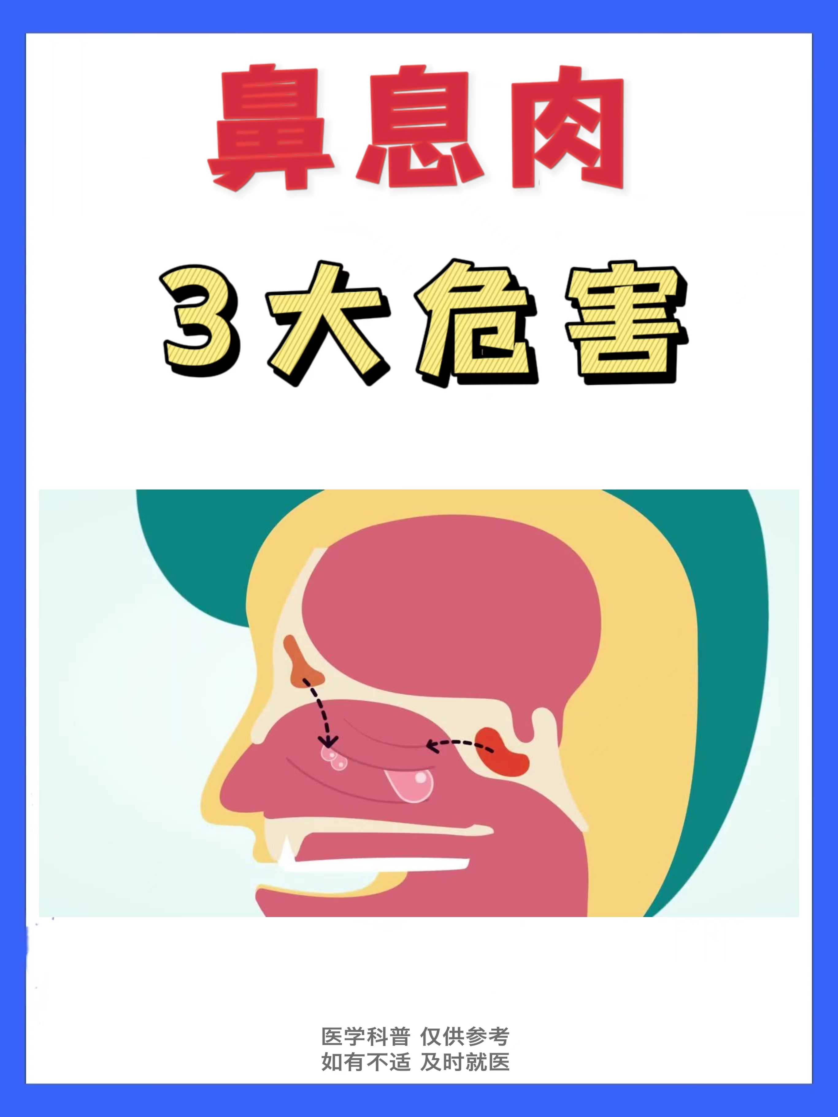 鼻息肉的3大危害不容忽视