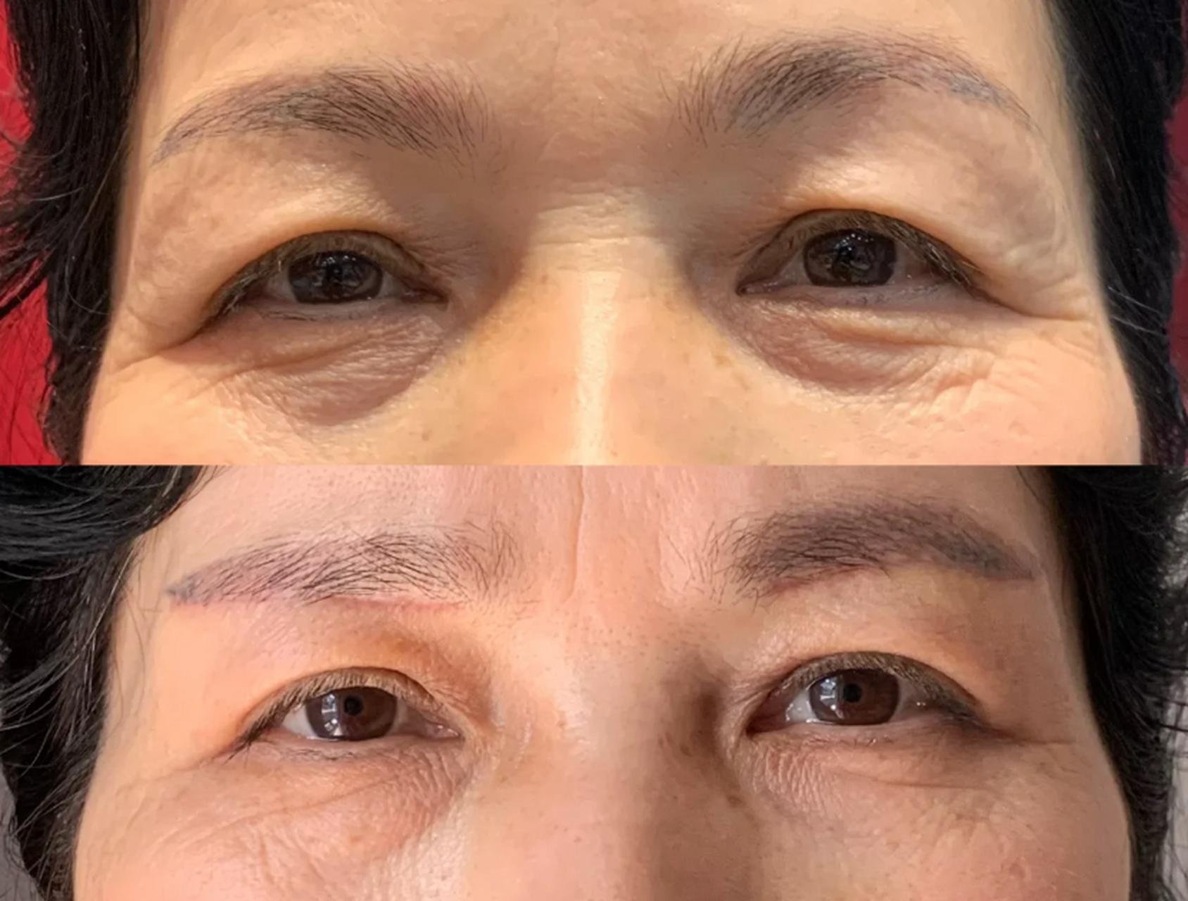 【真实案例分享】提眉前后对比图,姐妹们帮忙看下效果怎么样 年前带