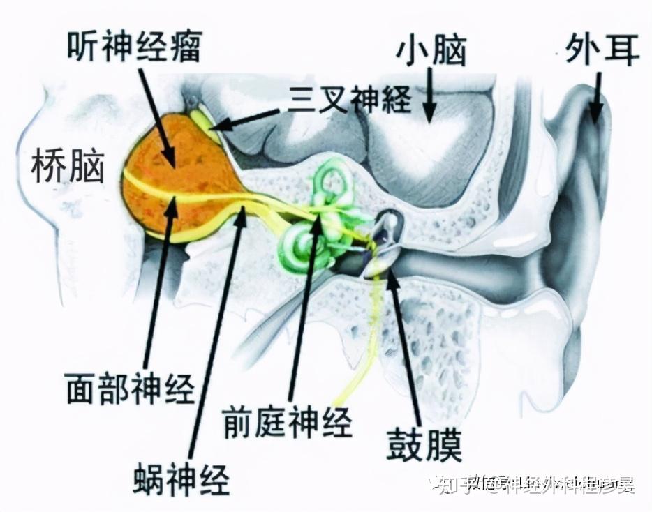 得了听神经瘤,如果不手术,会有什么后果?
