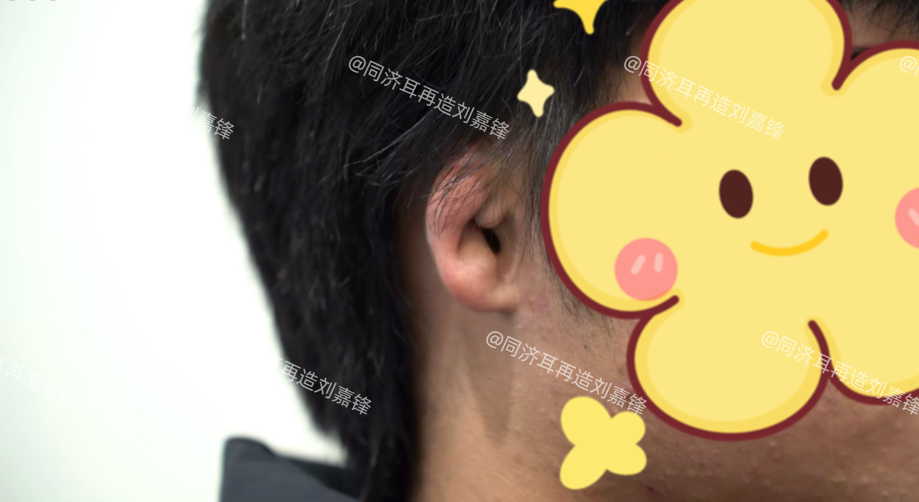 18岁男孩2度小耳畸形,因看错科室耽误了黄金治疗时间