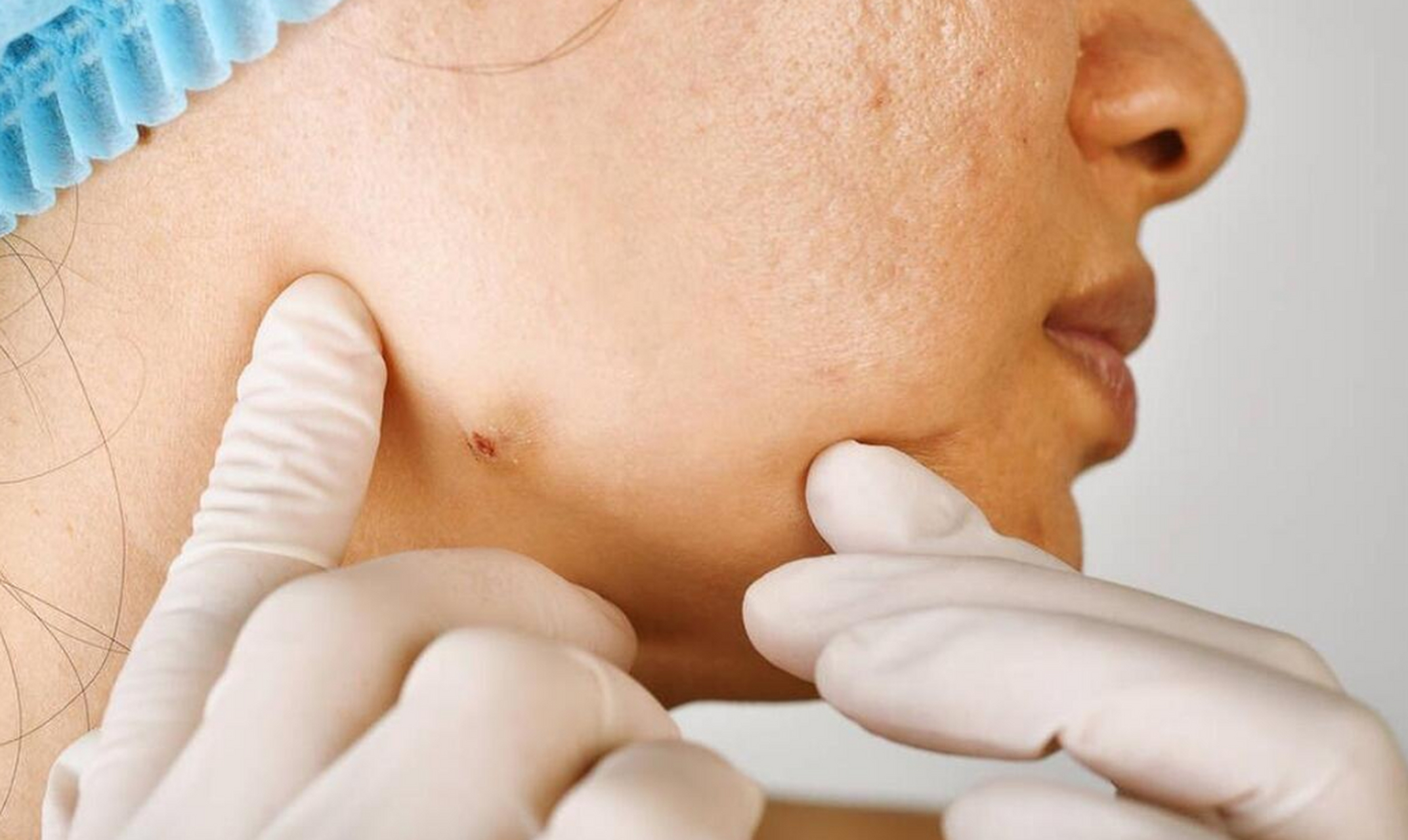 结节囊肿的常见类型与特点  结节囊肿是一种常见的健康问题,其分类