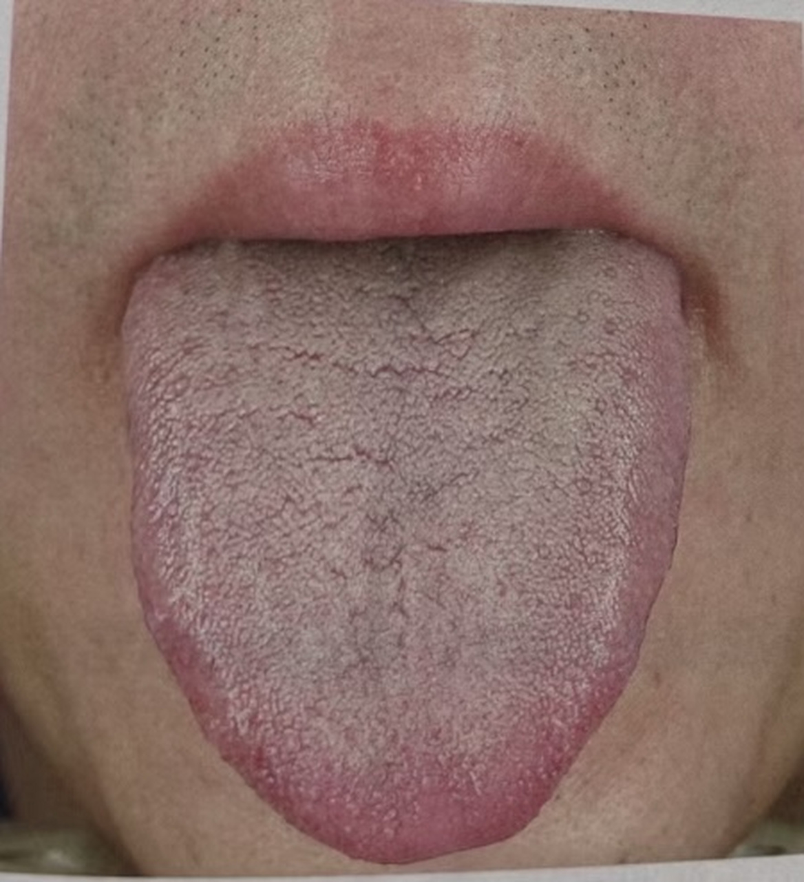 这种肾虚舌象不是直接补肾就可以了,要分清是肾阳虚还是肾阴虚  先看