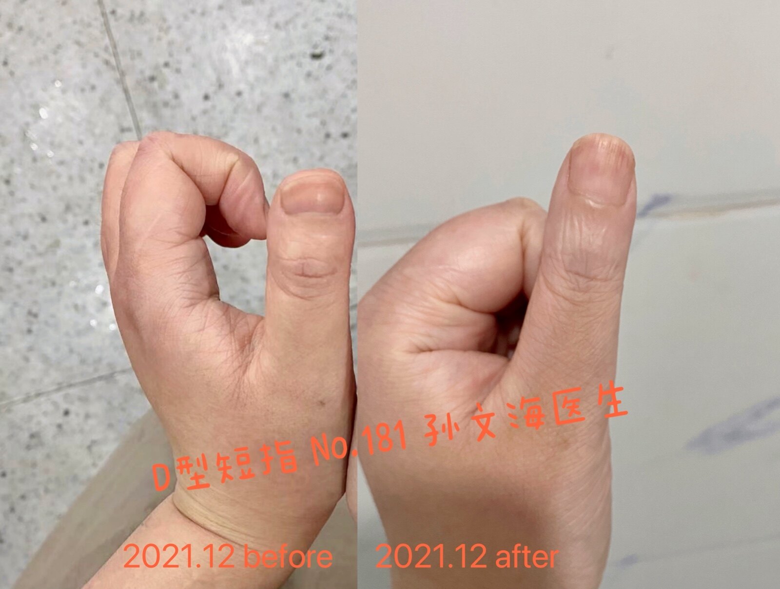 D型短指症的手术方法(附案例集)