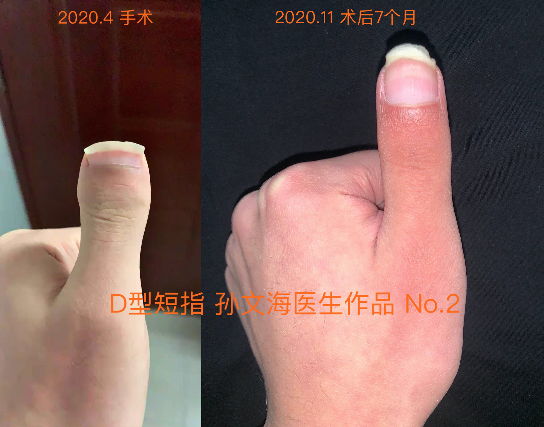 D型短指症的手术方法(附案例集)