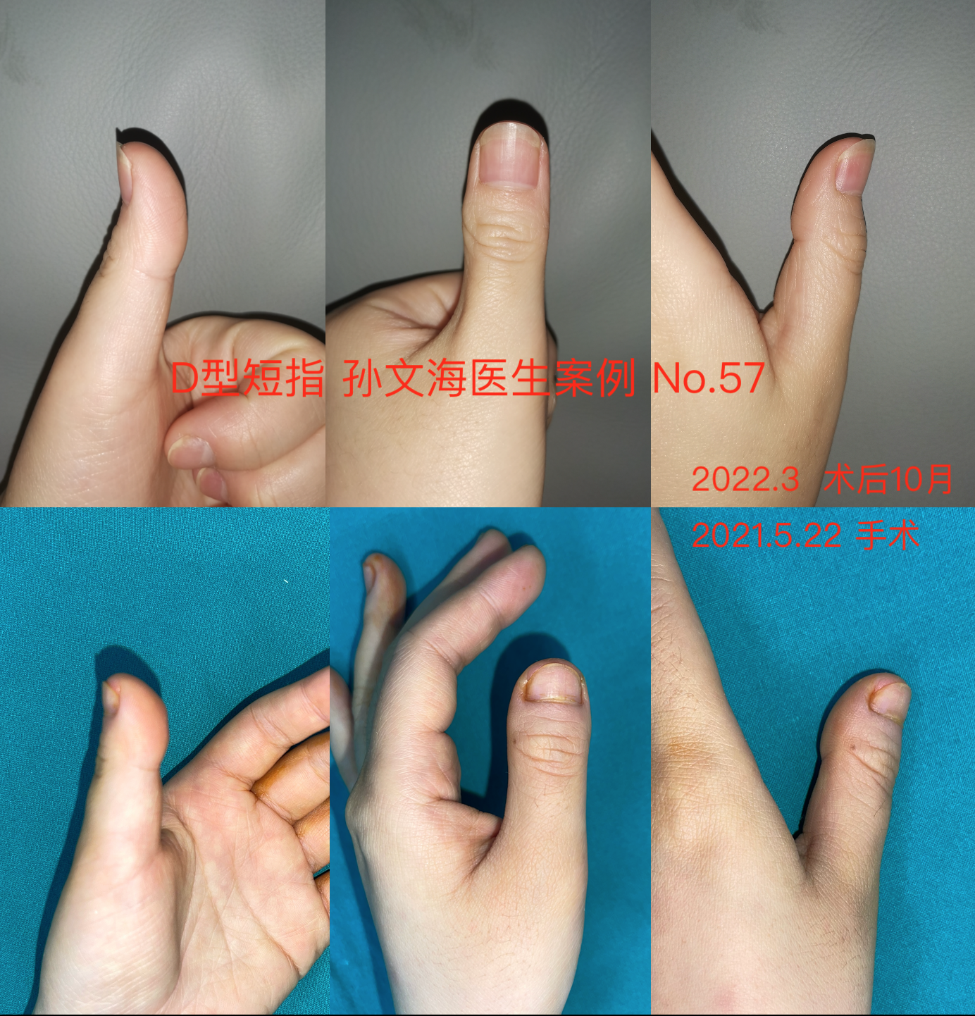 D型短指症的手术方法(附案例集)