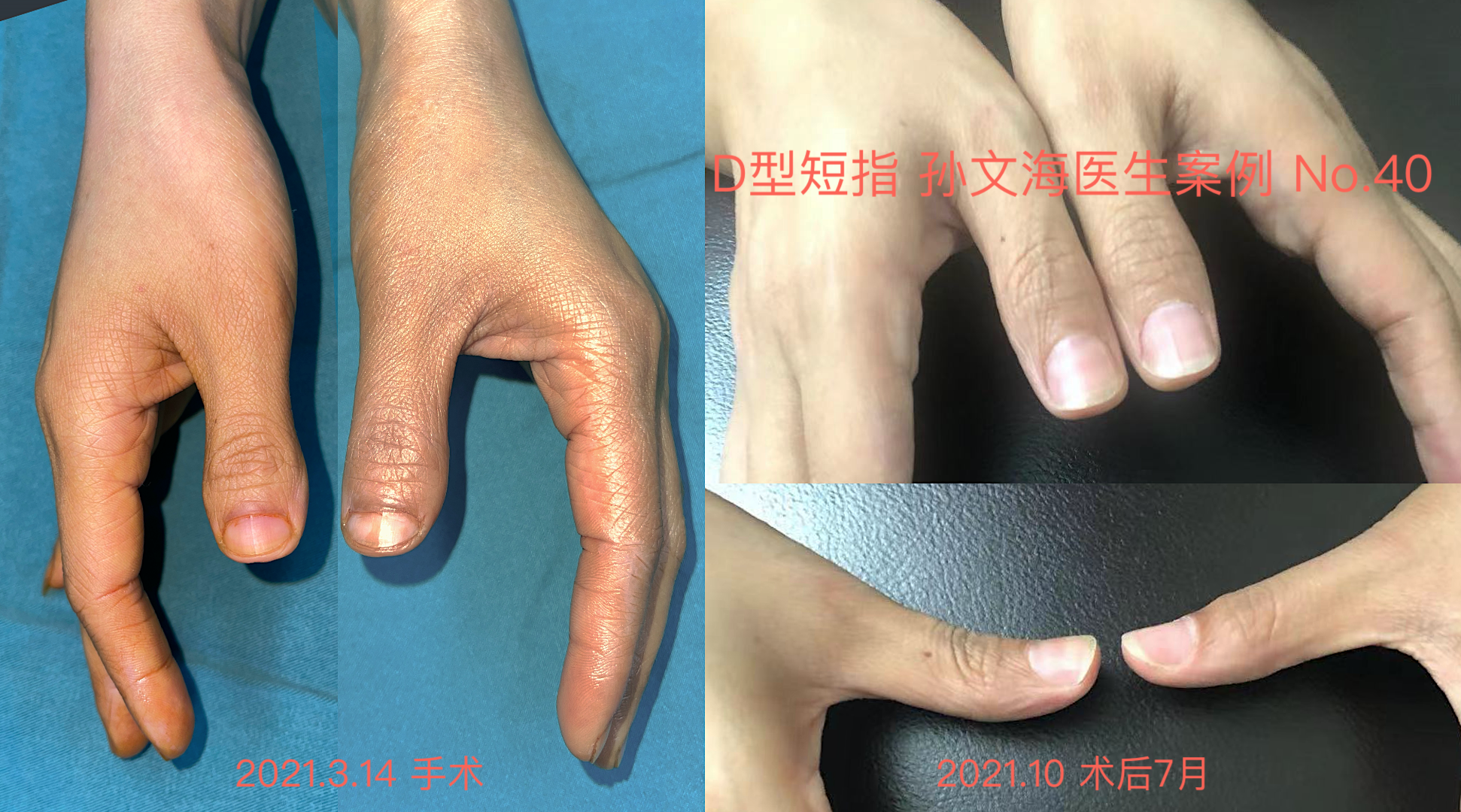 D型短指症的手术方法(附案例集)