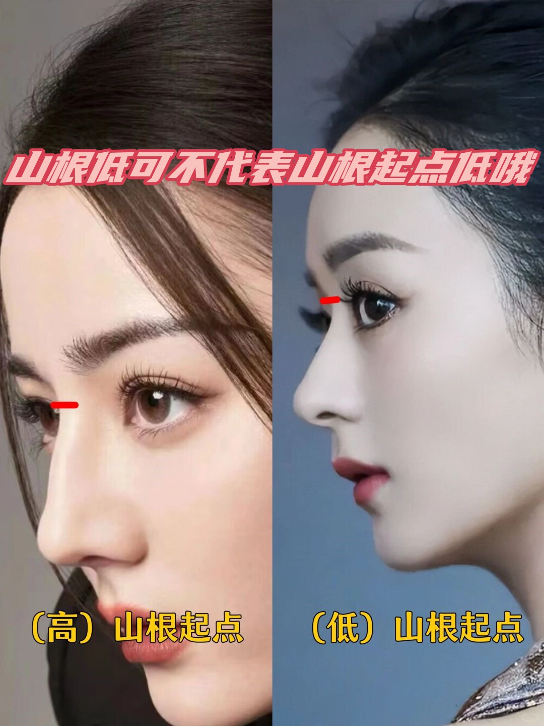 不过没有山根低山根低和塌鼻梁的区别图片低山根没有山根的鼻子山根
