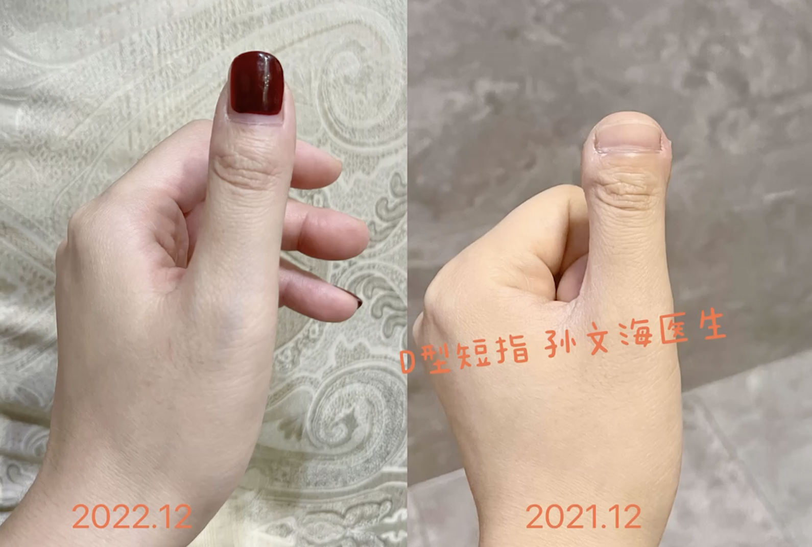 D型短指症的手术方法(附案例集)