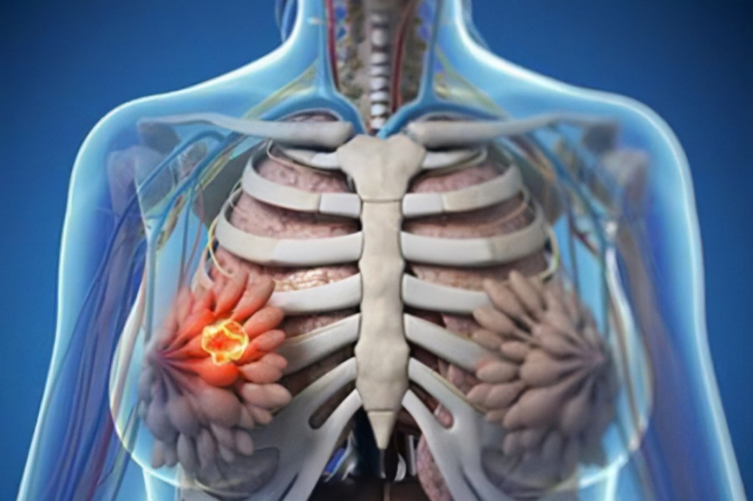 会出现乳房结节,脂肪粒以及有包块,这些都会影响到乳房的静脉血液回流