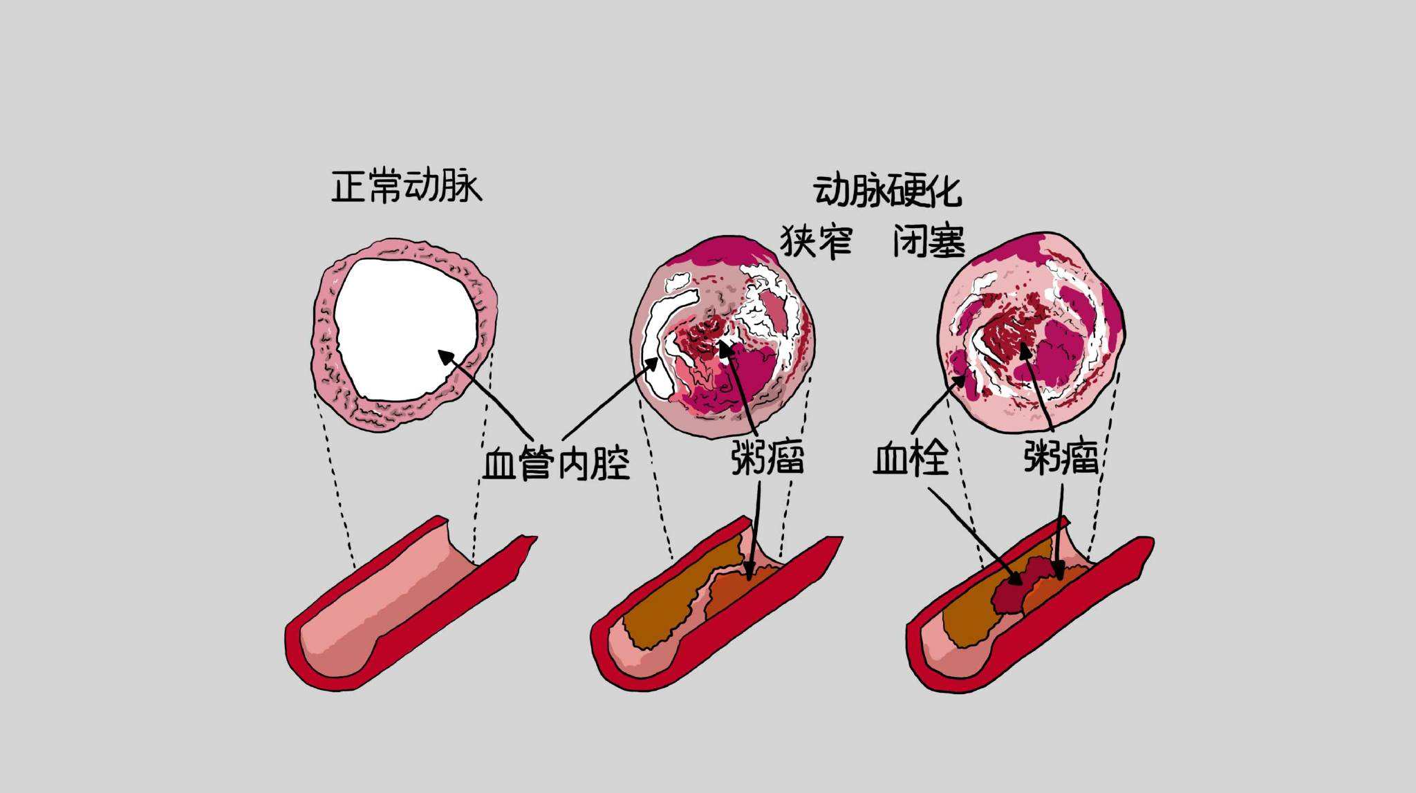 脑动脉硬化症状图片