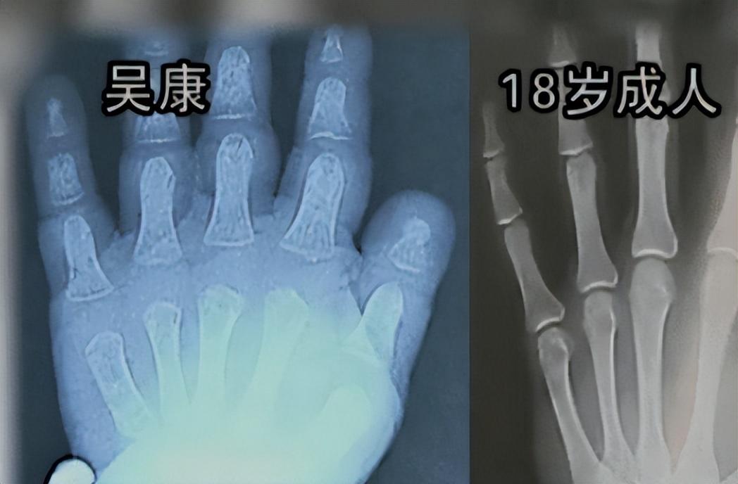 都没有什么区别,身高也有52cm,但是在出生之后吴康的症状就开始显现