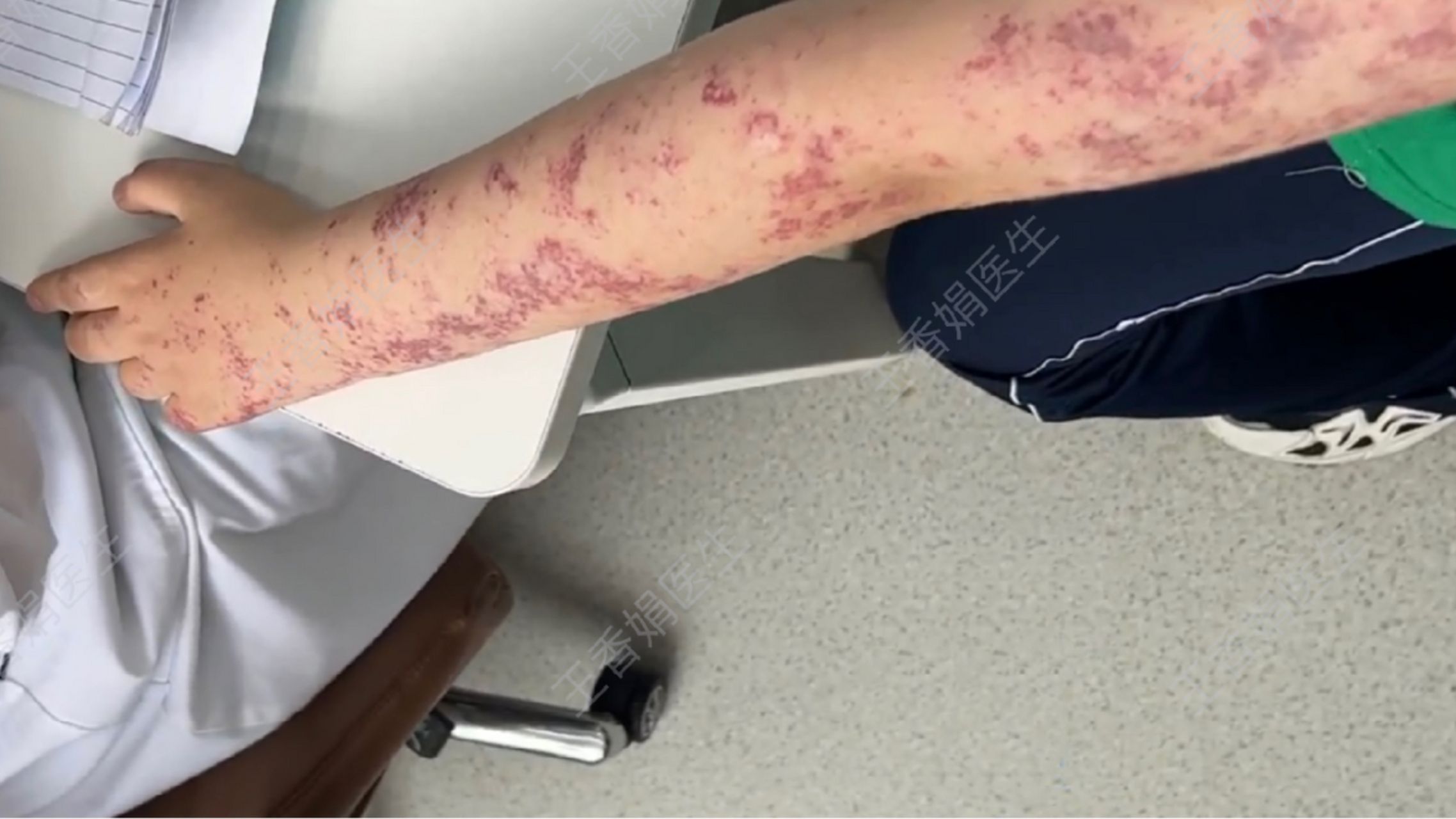 奶奶照看留守儿童,没注意胎记长满手臂  这位小朋友父母都在外地打工