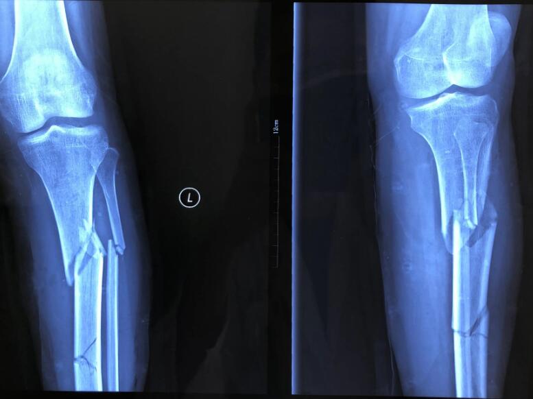 死骨在x线上表现为心脏支架移位片子图片钙补多了会出现什么情况人体