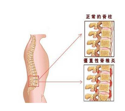 强直性脊柱炎位置图片