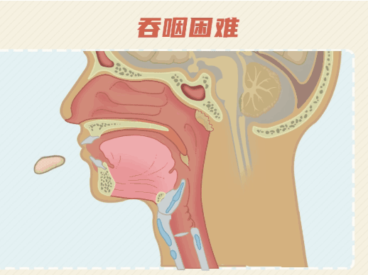 吞咽障碍康复——导管球囊扩张术的临床应用