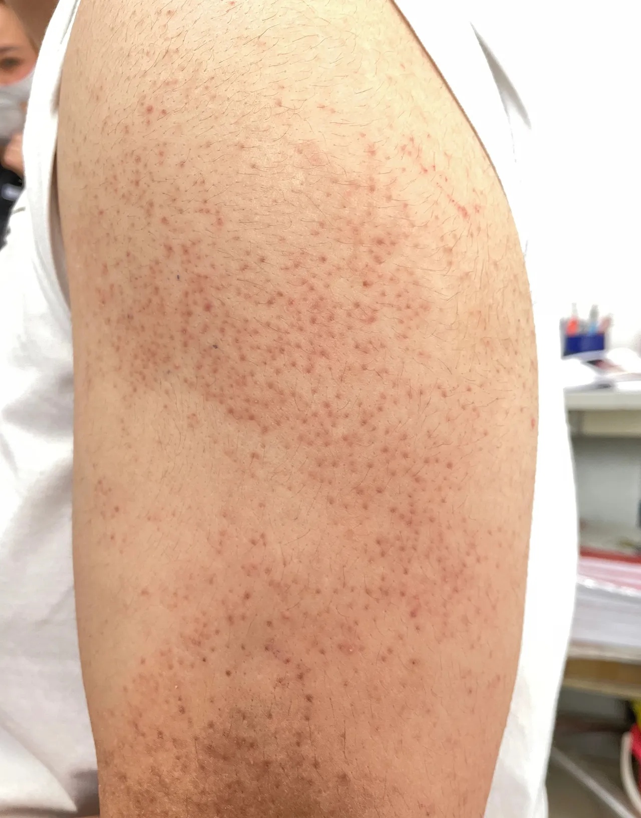 有些小朋友胳膊上总是起这.@皮肤科医生王世宁的动态