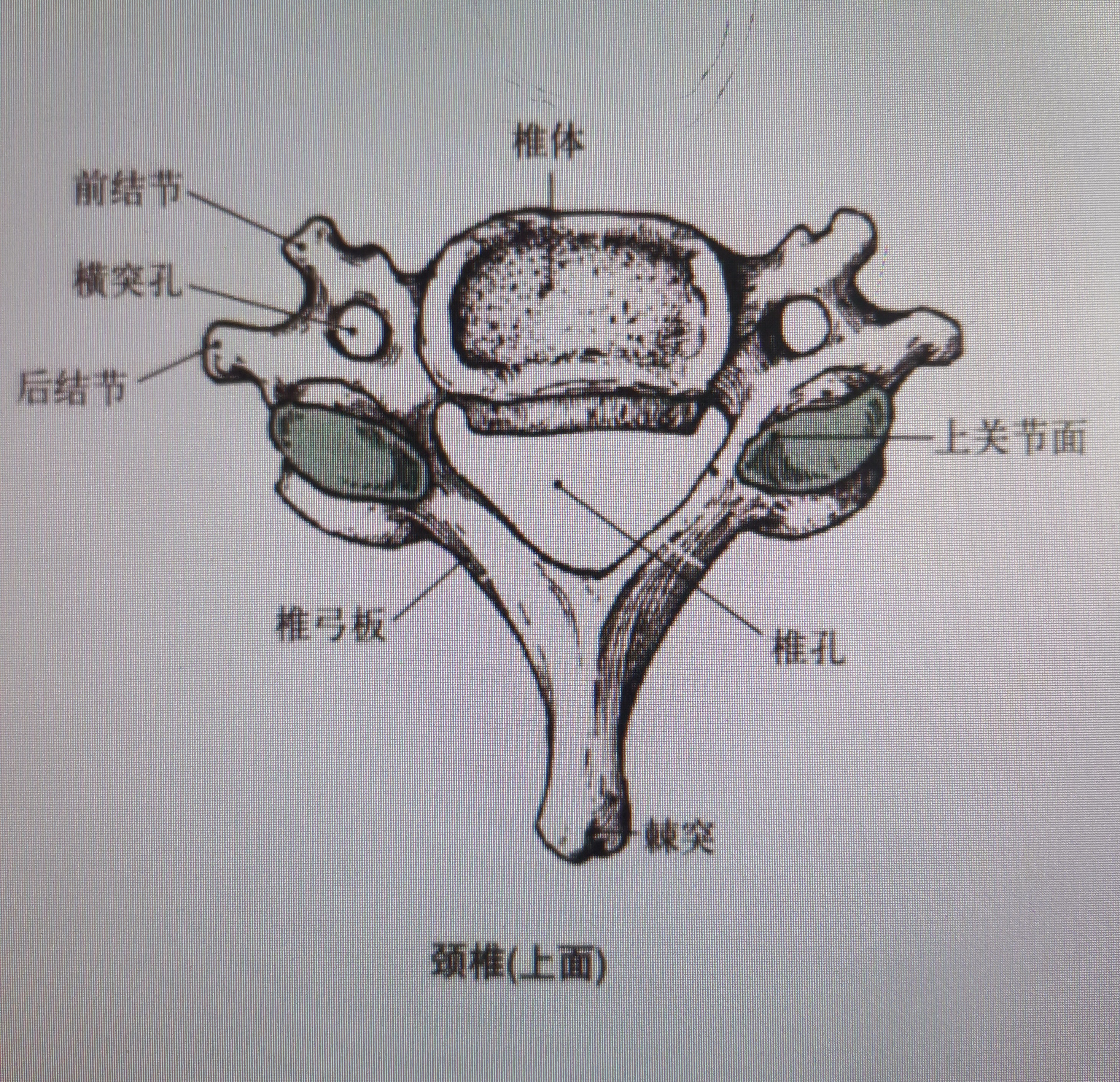 第六颈椎横突示意图图片