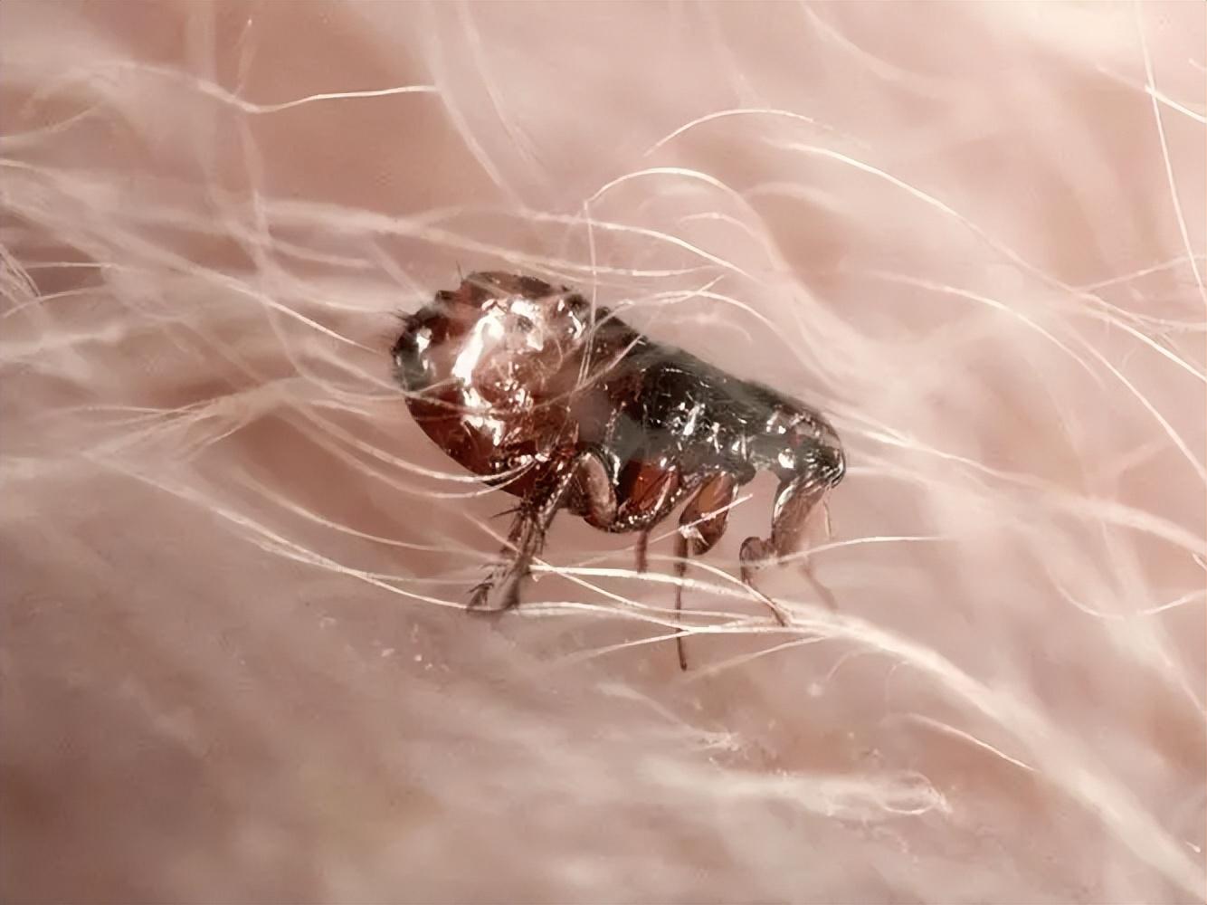 29岁女子腹部痒医生用镊子夹出16只阴虱原来它有4个传播途径