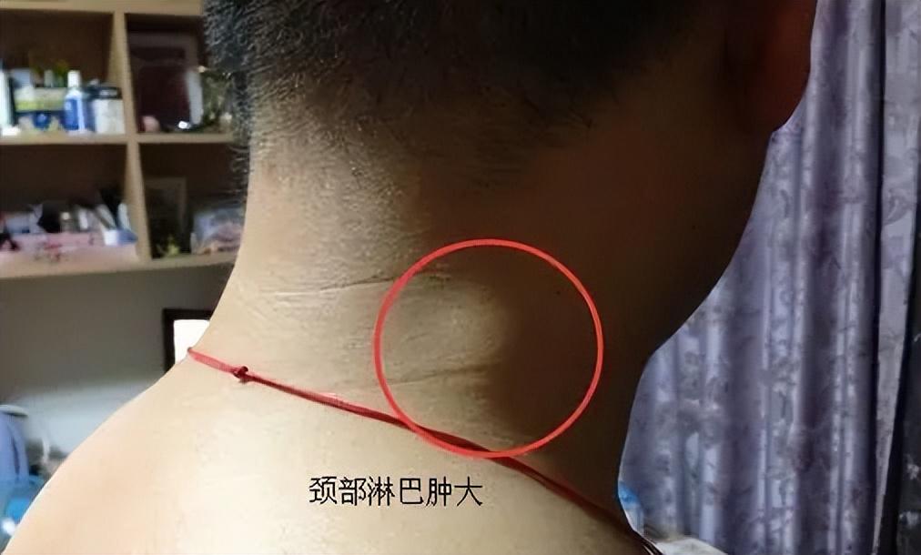 29岁女子腹部痒医生用镊子夹出16只阴虱原来它有4个传播途径