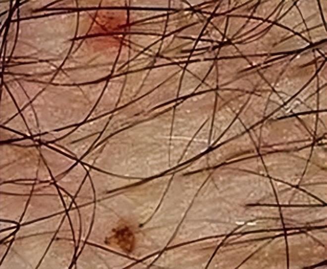 29岁女子腹部痒医生用镊子夹出16只阴虱原来它有4个传播途径