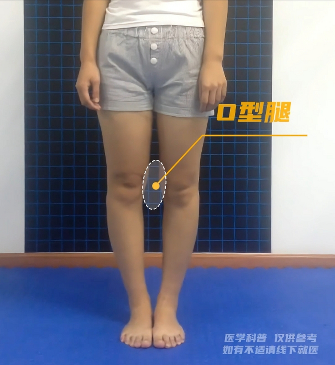 这位年轻女性有o型腿,膝盖和下肢内旋,膝过深.