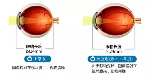 高度近视老了以后会瞎吗?