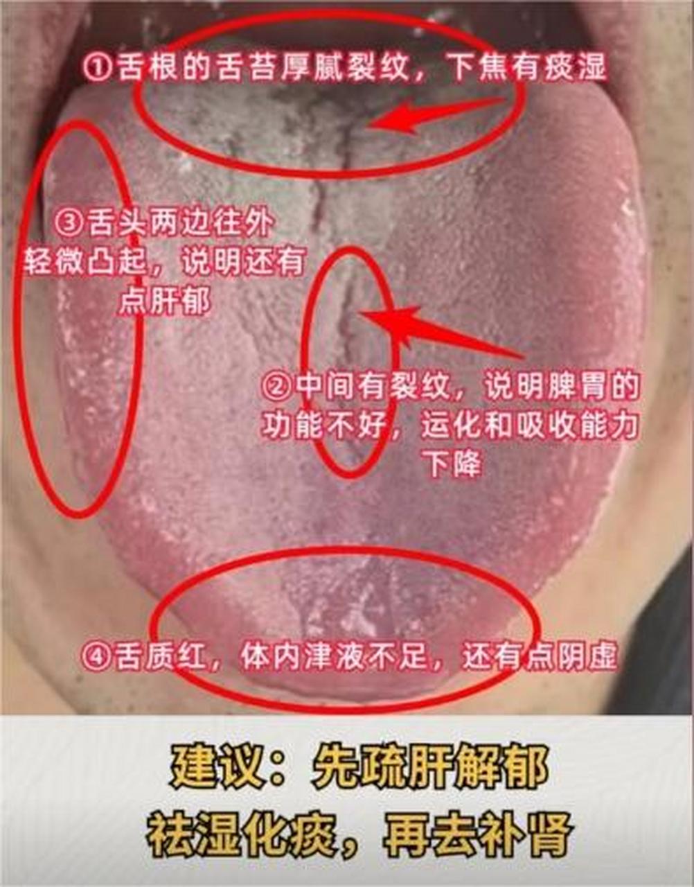 舌中裂纹延伸至舌根——下焦湿热,肝郁化火,脾肾两虚  2,舌根处舌苔白