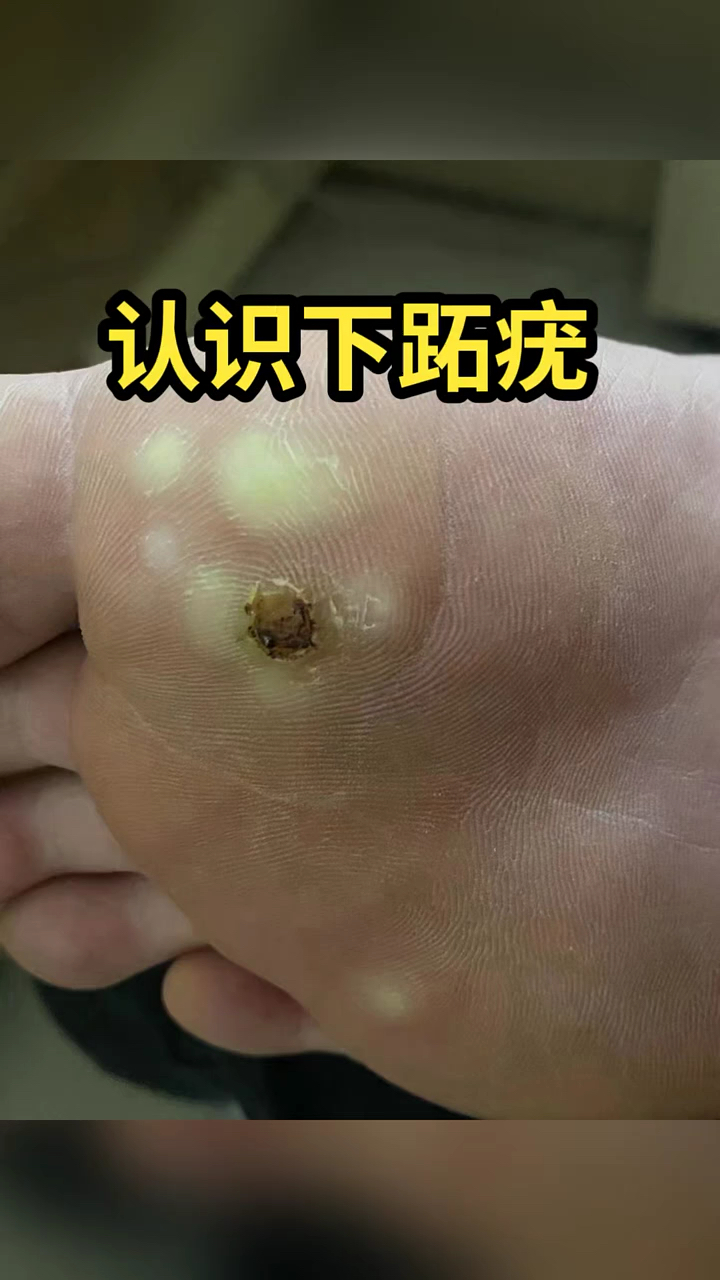 跖疣处理修复过程