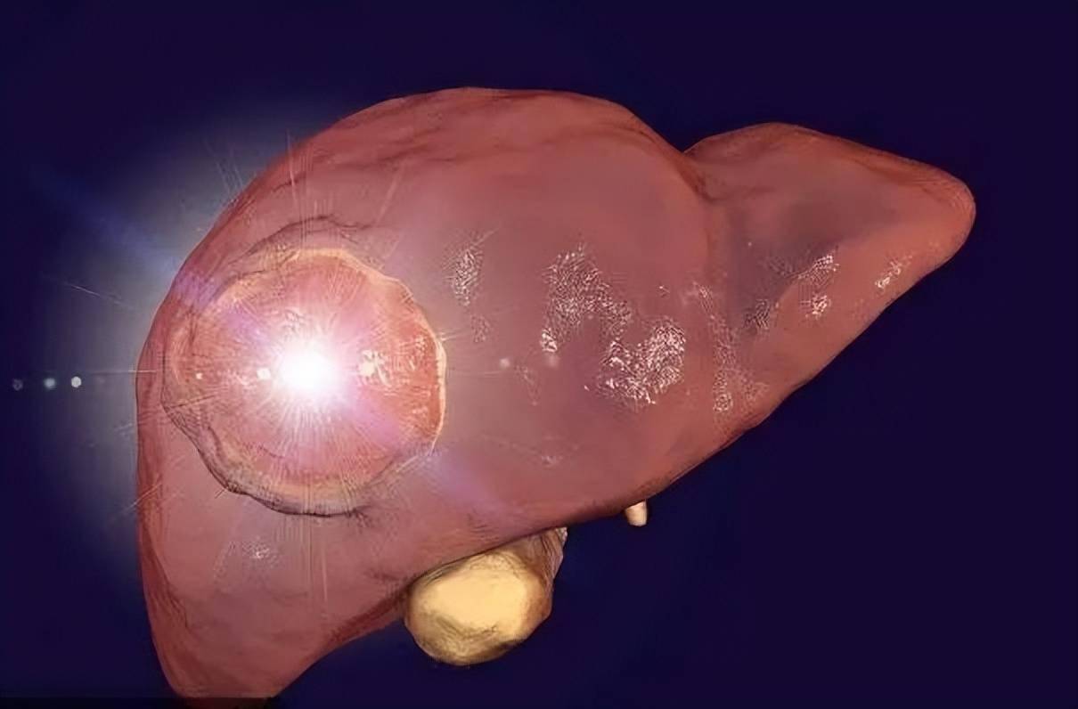 女子每月染发1次,10年后竟得肝硬化?医生:染发时,5点铭记于心