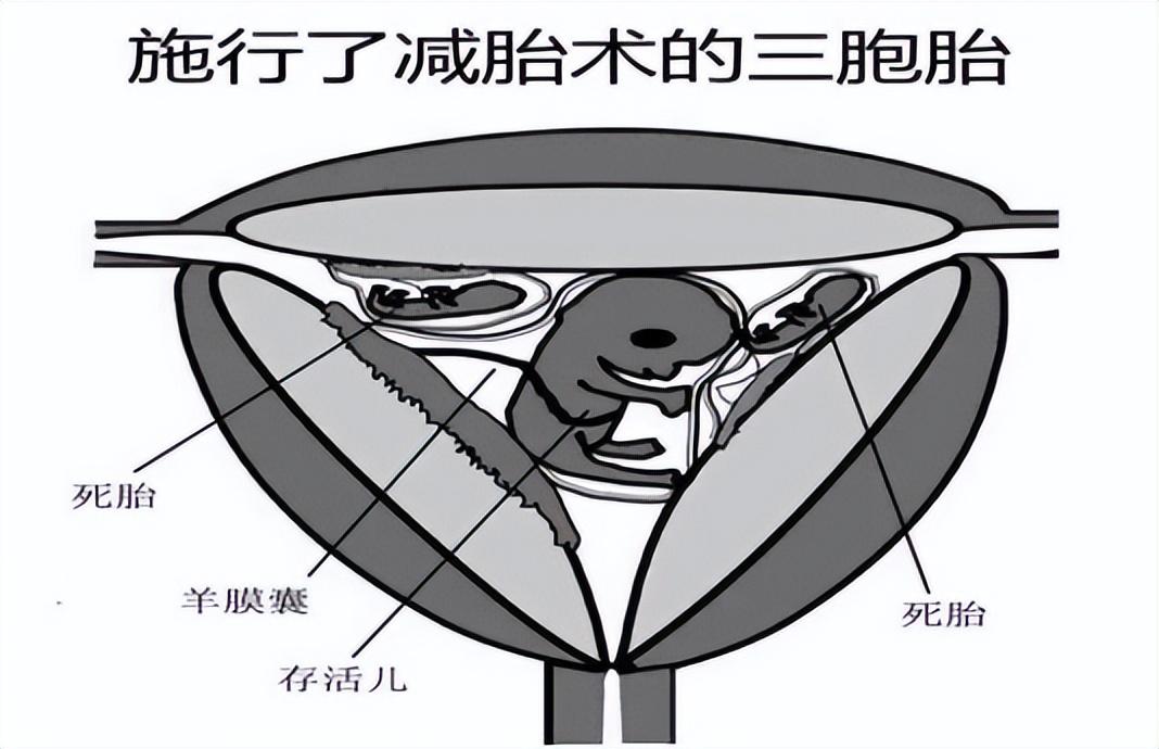 回顾中国首例5胞胎爸爸劳累过世孩子们已20岁在上大学