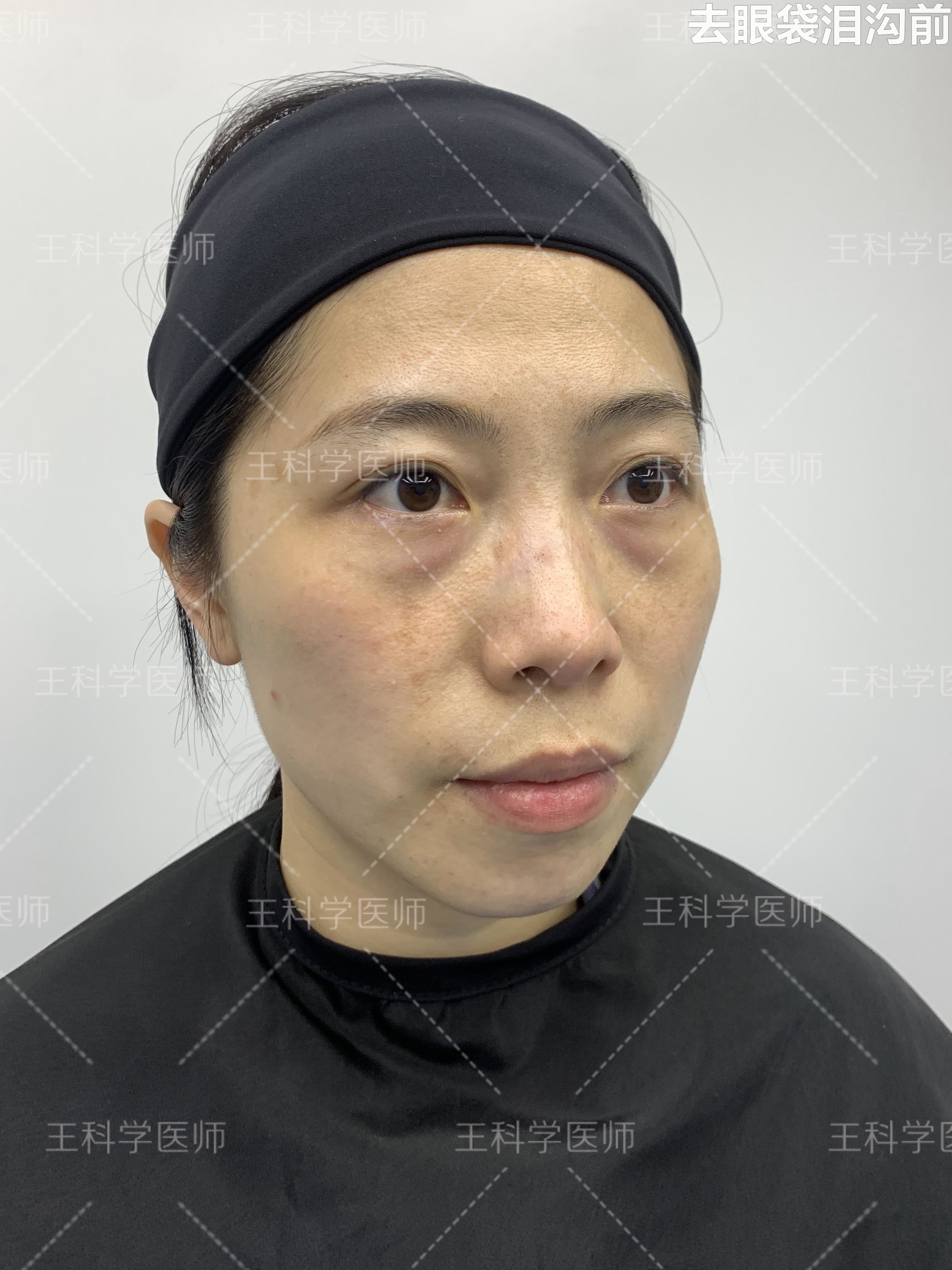 这个姑娘只有三十多岁,但眼袋非.@王科学医师的动态