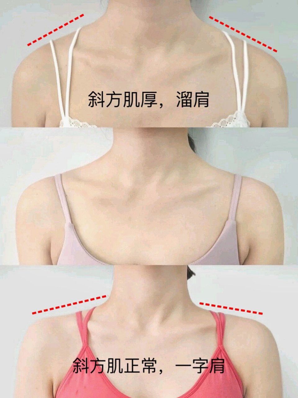 如何消除高耸的斜方肌