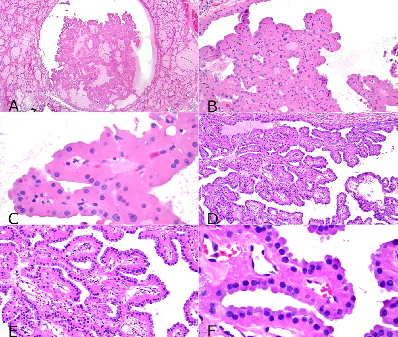 当甲状腺滤泡上皮来源肿瘤中嗜酸遇上乳头