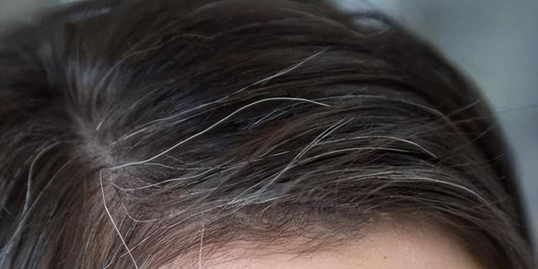 为什么有些人十几岁就有白头发为什么在线 为什么有些人十几岁就有白头发为什么在线