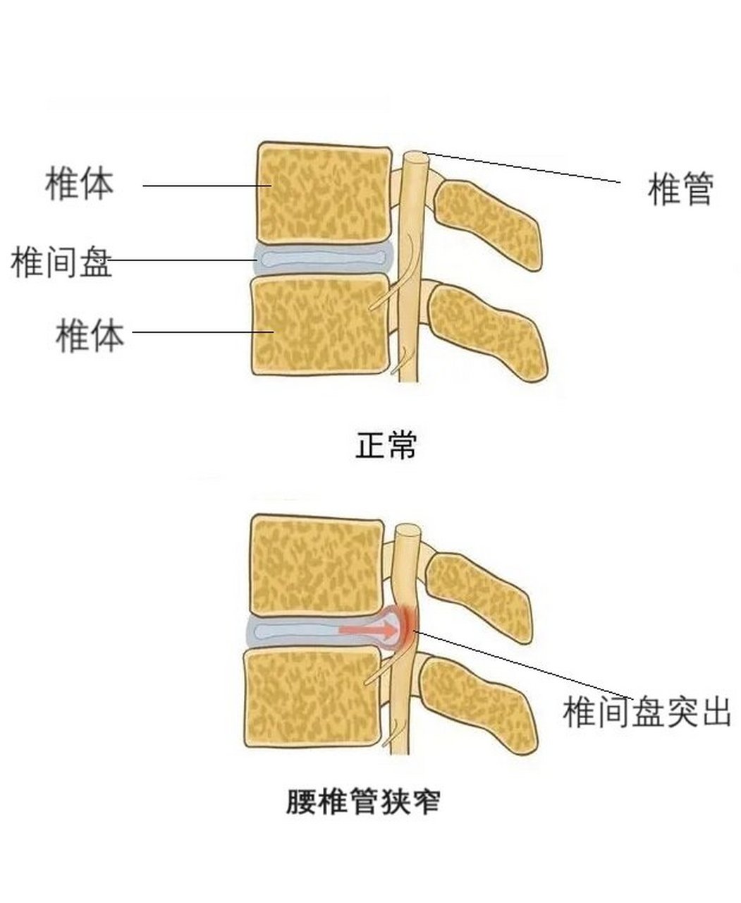 腰椎间盘突出和腰椎管狭窄到底有没有关系?