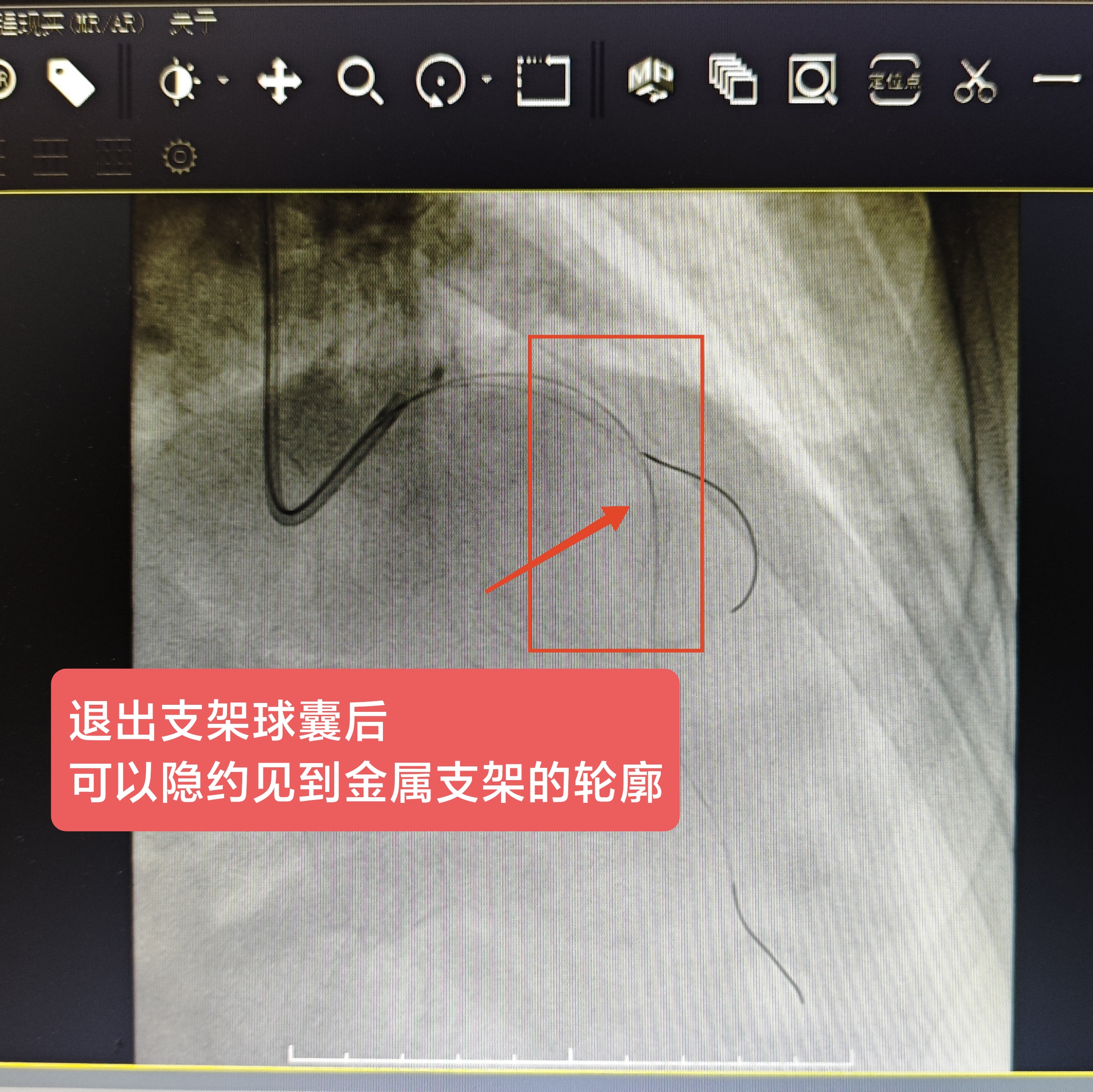 心脏支架从哪里放进去图片