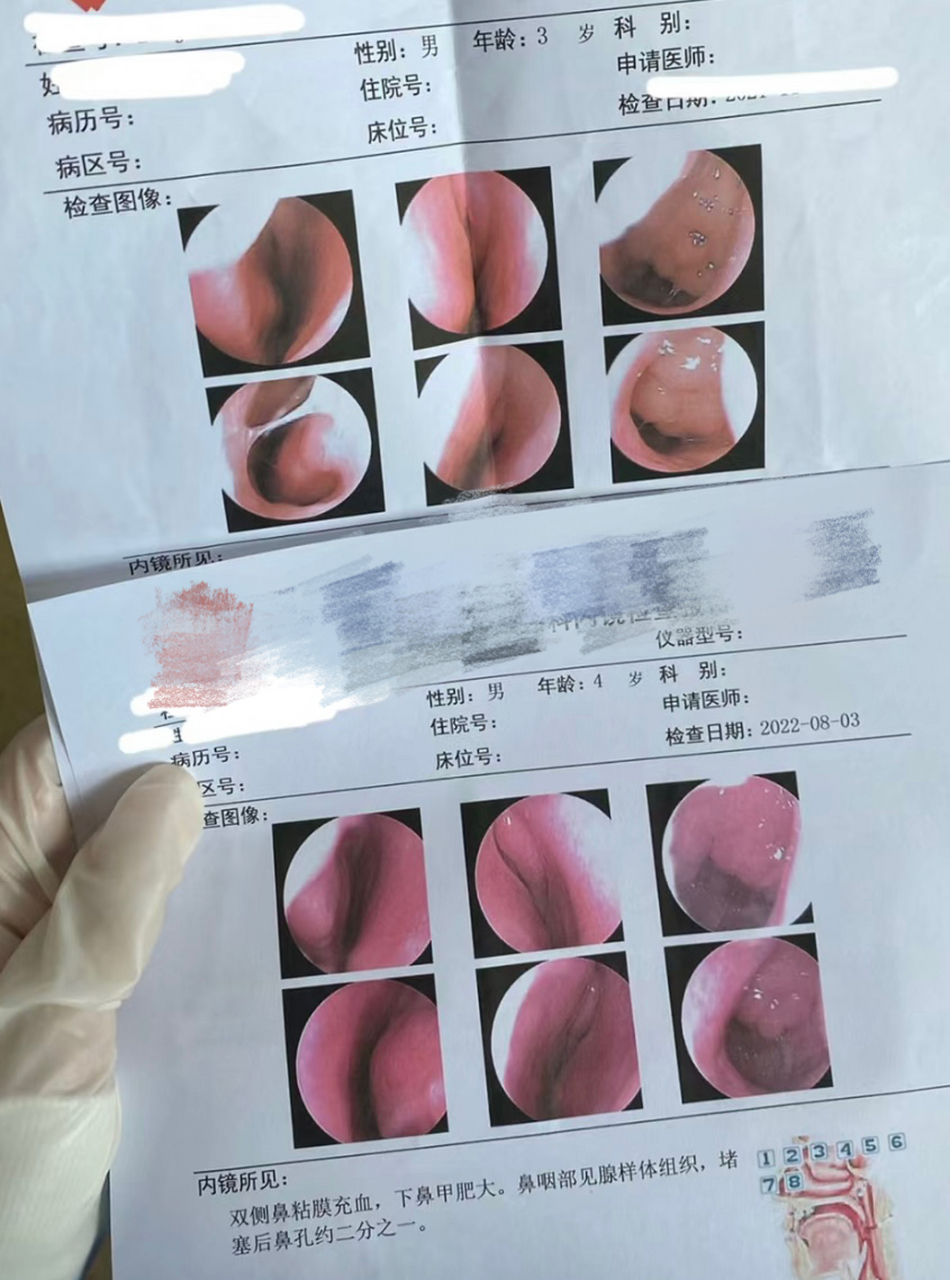 3月的第一个好消息,再见吧,腺样体肥大!