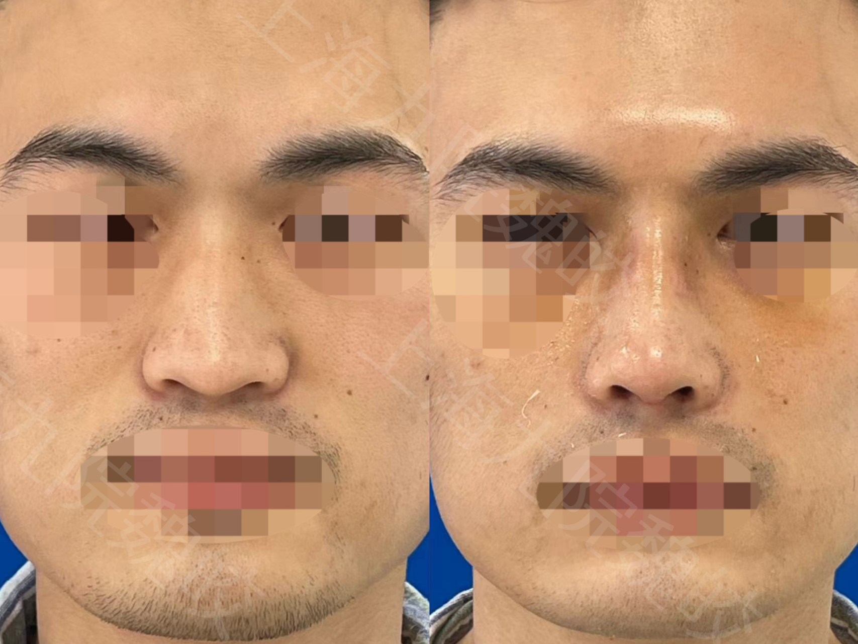 很扁塌,而且鼻梁不高,侧面线条弯弯曲曲,感觉鼻子整体不立体也不好看