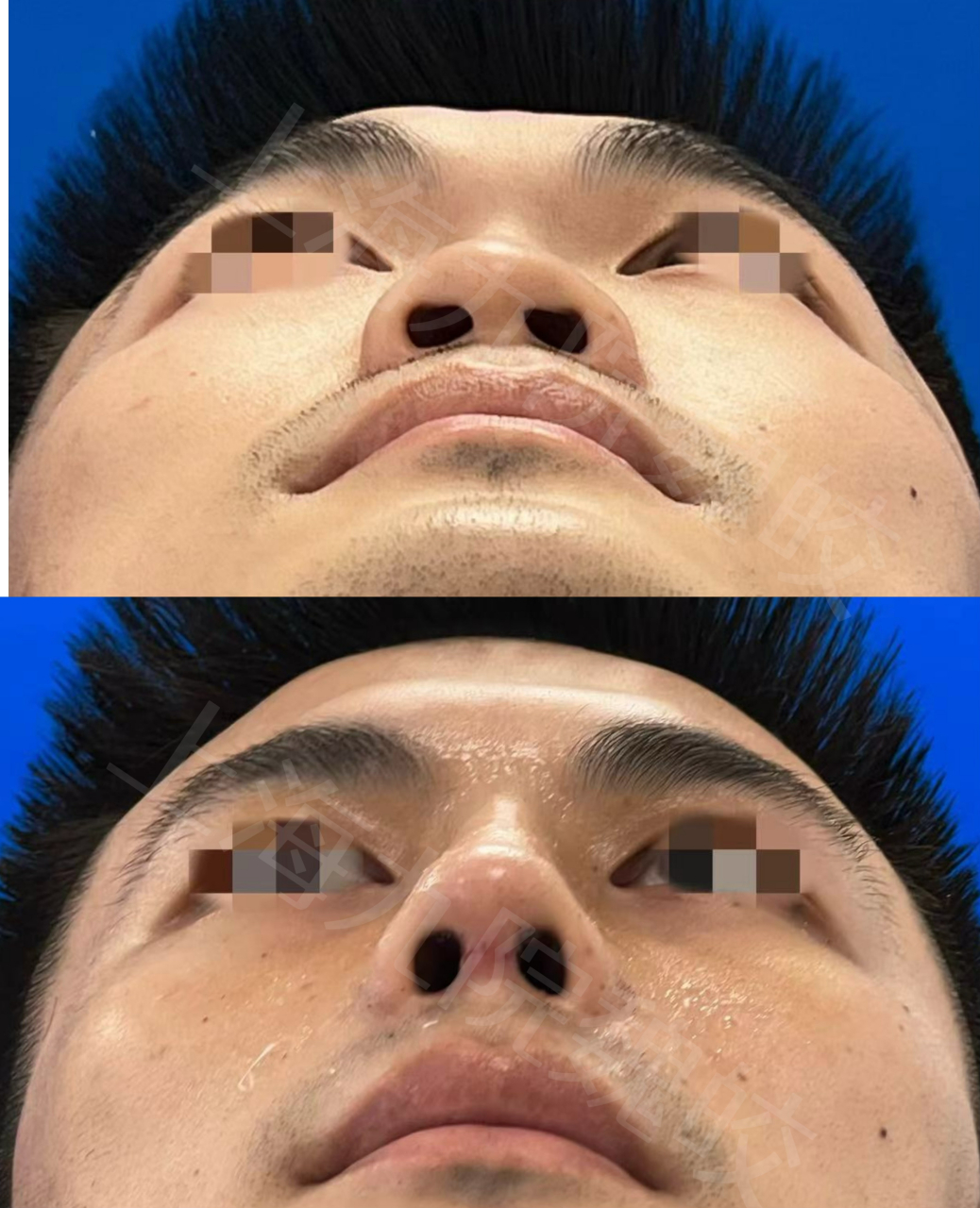 这个小伙子自述鼻头大,很扁塌,而且鼻梁不高,侧面线条弯弯曲曲,感觉