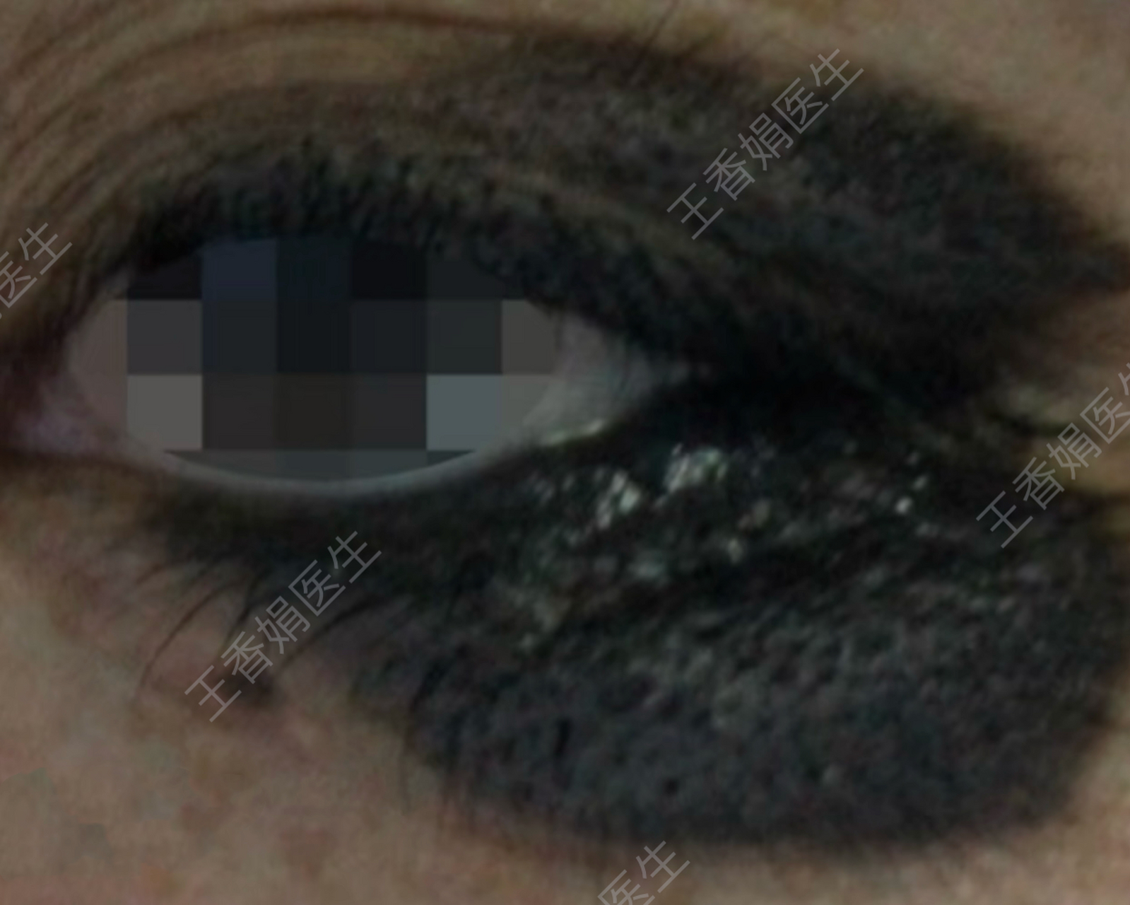 眼周黑胎记被嘲笑,年纪轻轻生活却没了奔头  这位女士眼周长了一块黑