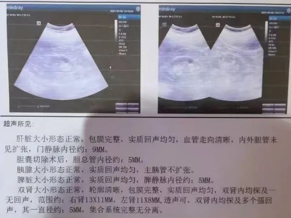 痛风肾超声表现图片