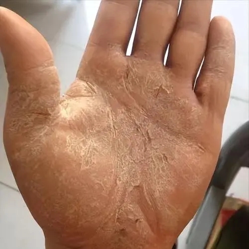 手掌干裂脱皮的原因,直击心灵的真相解析!
