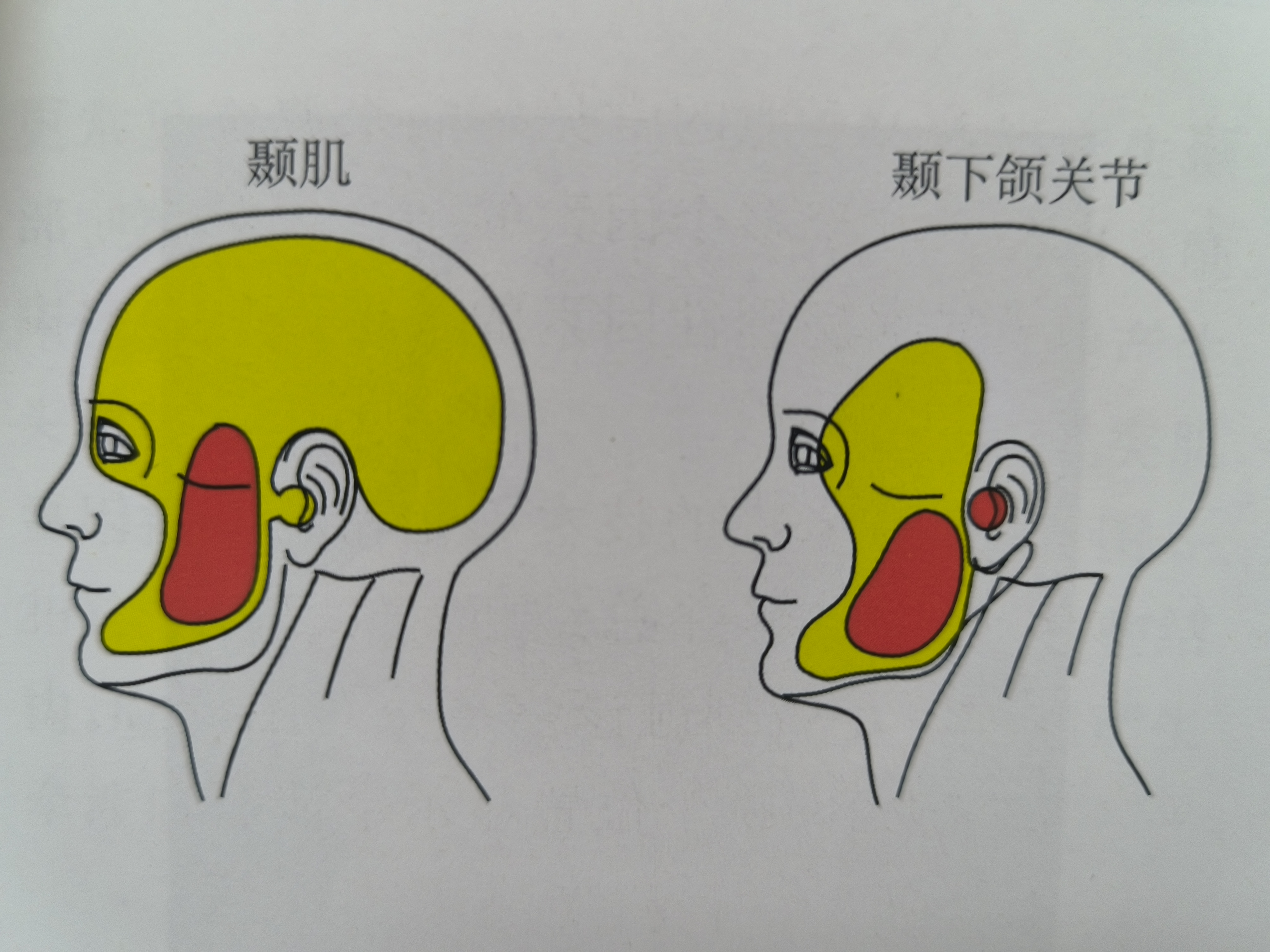 颞肌疼痛图片