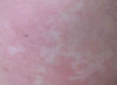 而且贫血痣不影响健康,不要把它当做白癜风,花斑藓等相似症状去治疗