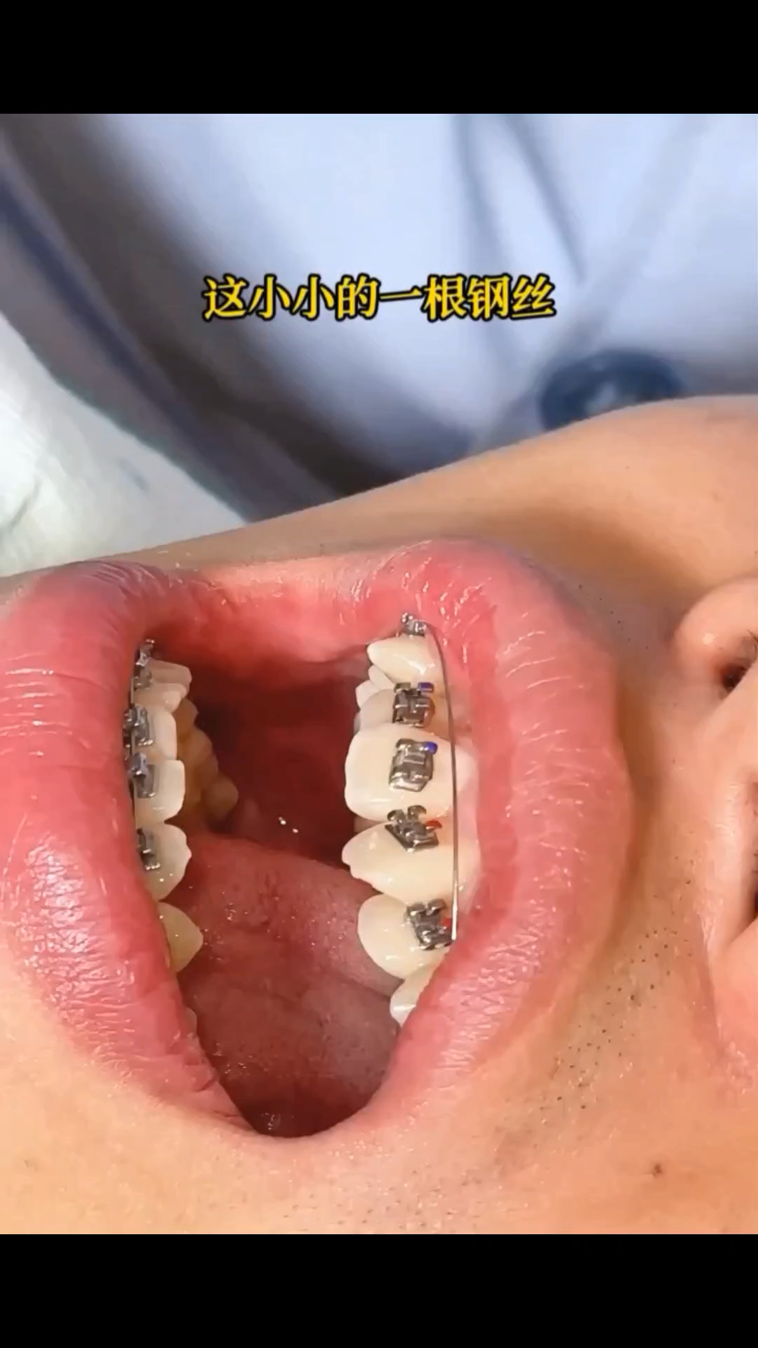 一根钢丝将歪歪曲曲牙齿矫正